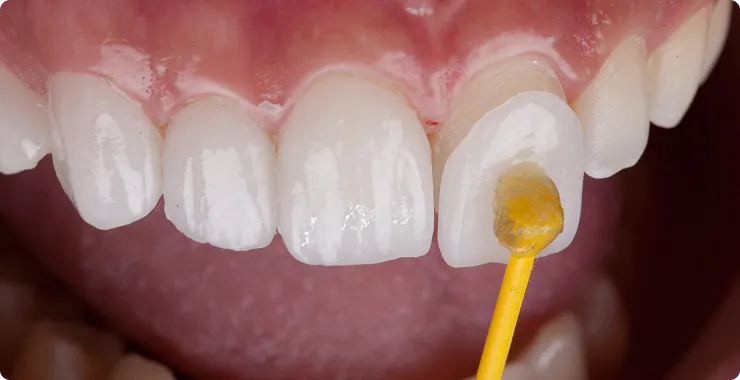 ラミネートベニア